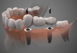 Como Funciona o Tratamento de Implantes Prétese Fixa Tipo Protocolo