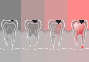 O-que-é-Endodontia-e-Quais-São-os-Tratamentos-capa