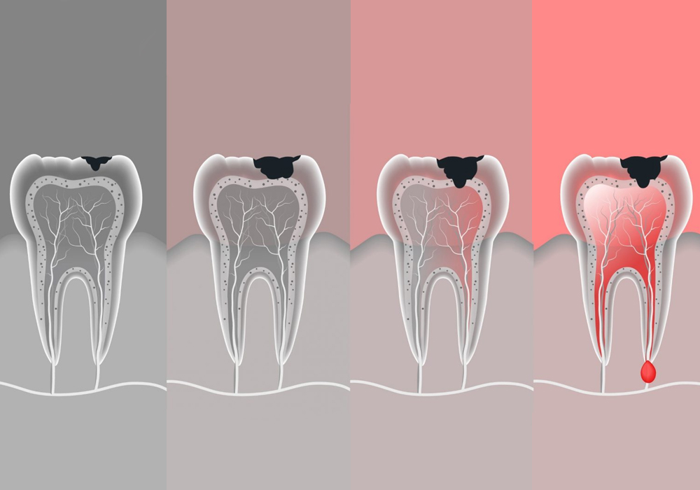 O Que é Endodontia E Quais São Os Tratamentos? – Oral Unic