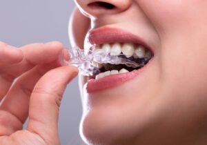 Aparelho-Invisível-Funciona-Descubra-As-Principais-vantagem-Desse-Modelo