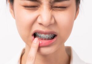 E Normal o Dente Ficar Um Pouco Mole Após Colocar Aparelho?