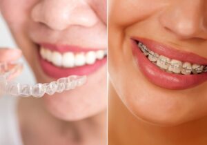 qual-a-diferença-de-aparelho-ortodôntico-e-estético-capa